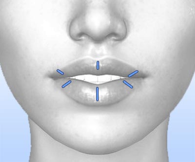 scars lip augmentation