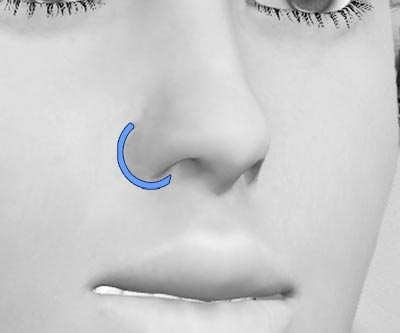 scars revision rhinoplasty - III